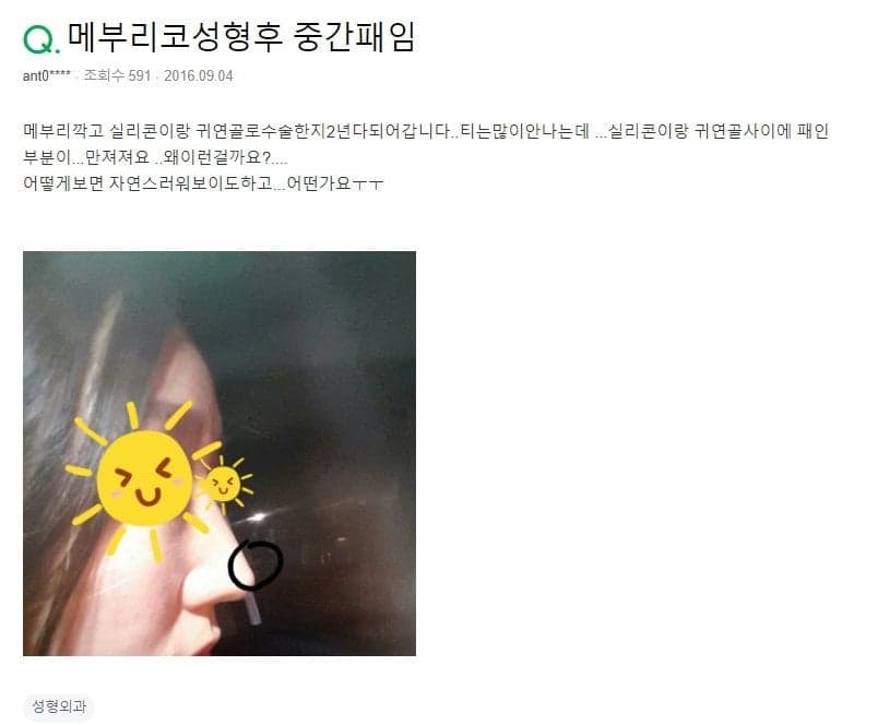 매부리코 수술 2년 뒤, 실리콘과 귀연골 경계가 꺼져 보인다면 — 코함몰일까요? 관련 이미지 2/2