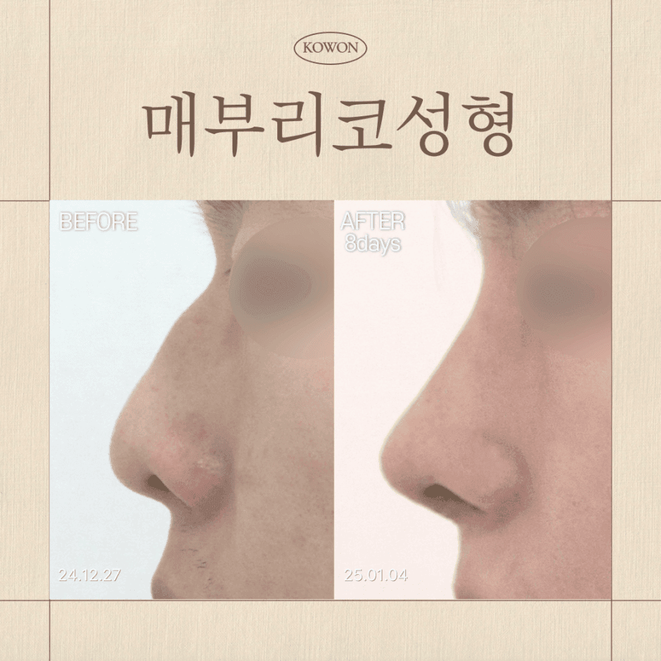 매부리코성형, 무보형물로 가능한 유형은 따로 있습니다 — 유형 구분과 수술 방법 관련 이미지 1/3