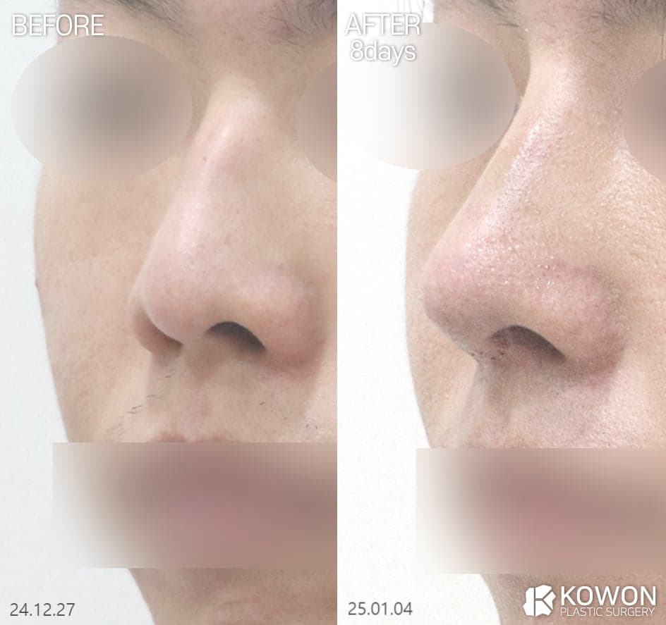 매부리코성형, 무보형물로 가능한 유형은 따로 있습니다 — 유형 구분과 수술 방법 관련 이미지 2/3