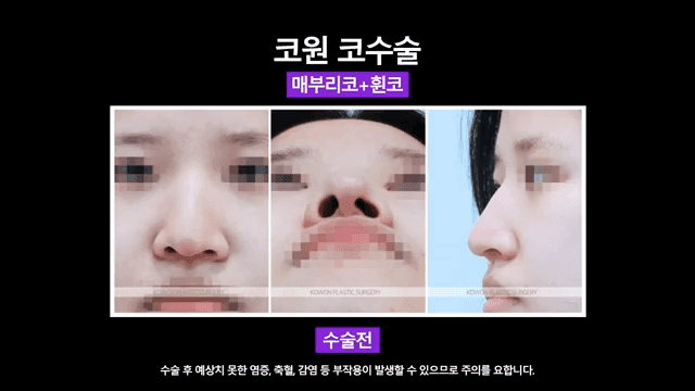 매부리코수술로 콧구멍 비대칭까지 본 사례 — 난도가 높아지는 이유와 확인 순서 관련 이미지 4/8