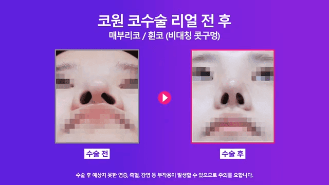 매부리코수술로 콧구멍 비대칭까지 본 사례 — 난도가 높아지는 이유와 확인 순서 관련 이미지 5/8