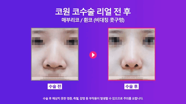 매부리코수술로 콧구멍 비대칭까지 본 사례 — 난도가 높아지는 이유와 확인 순서 관련 이미지 6/8