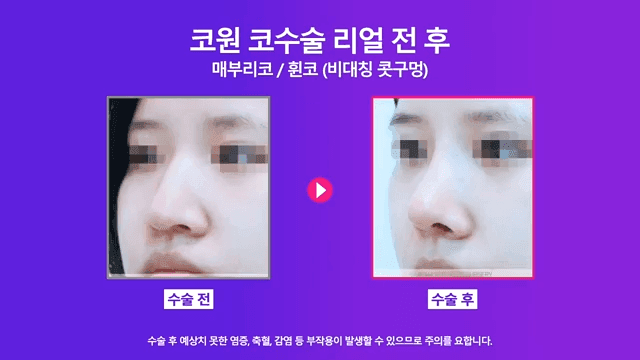 매부리코수술로 콧구멍 비대칭까지 본 사례 — 난도가 높아지는 이유와 확인 순서 관련 이미지 7/8
