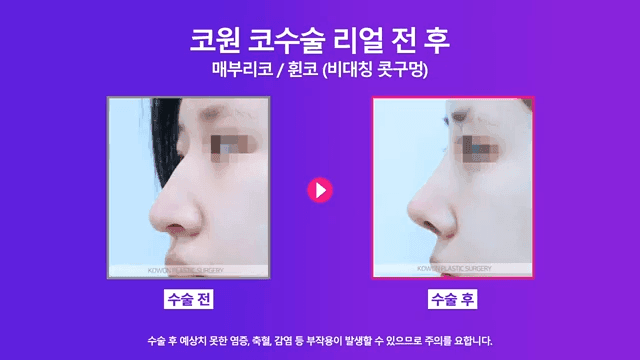 매부리코수술로 콧구멍 비대칭까지 본 사례 — 난도가 높아지는 이유와 확인 순서 관련 이미지 8/8