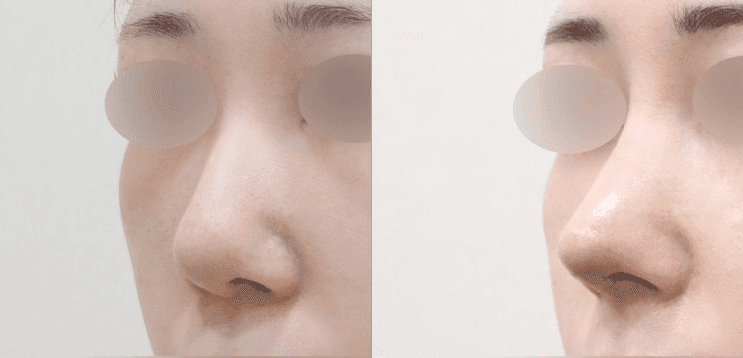 매부리코 수술 2개월, 아직도 욱신거리면 염증인가요? — 통증을 확인하는 순서 관련 이미지 3/5