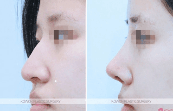매부리코 수술 2개월, 아직도 욱신거리면 염증인가요? — 통증을 확인하는 순서 관련 이미지 5/5