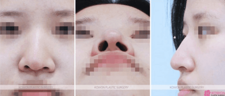 วิธีการผ่าตัดและสาเหตุจมูกโหนก— สรุปโดย Knowledge iN คำถามและกรณีศึกษาเกี่ยวกับการแก้ไขหลังค่อม รูปภาพที่เกี่ยวข้อง 5/9