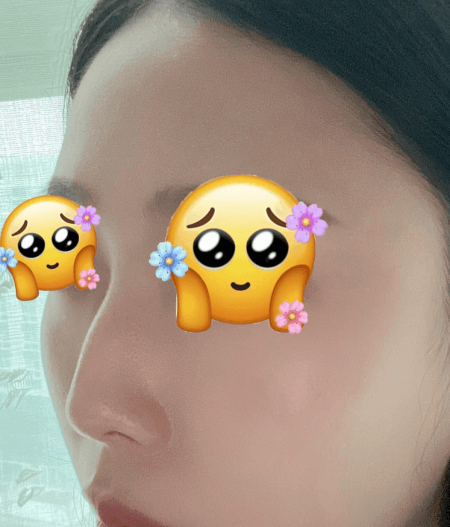 매부리코교정과 비염수술을 함께 진행한 사례 — 무보형물·귀연골로 계획한 이유 관련 이미지 1/14