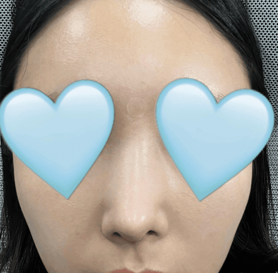 매부리코교정과 비염수술을 함께 진행한 사례 — 무보형물·귀연골로 계획한 이유 관련 이미지 3/14