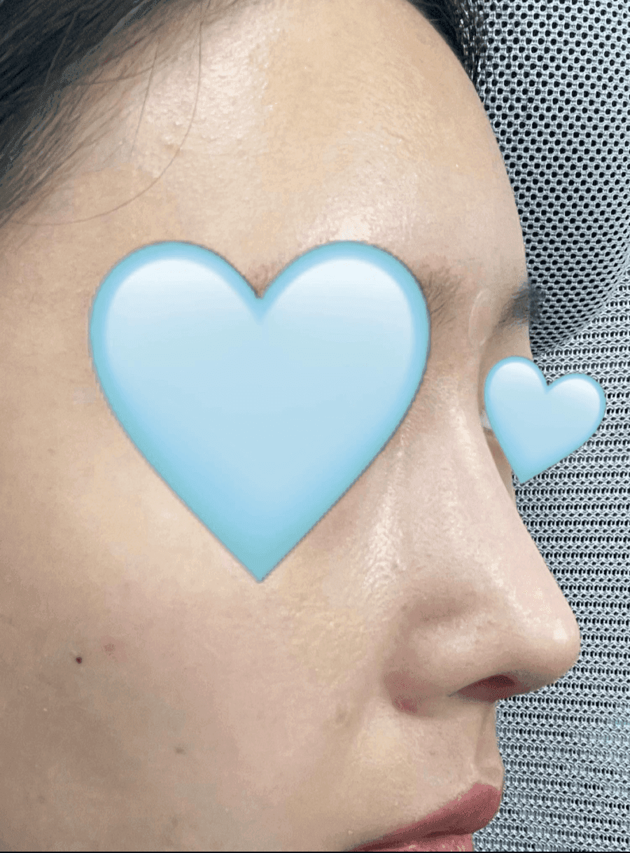 매부리코교정과 비염수술을 함께 진행한 사례 — 무보형물·귀연골로 계획한 이유 관련 이미지 4/14