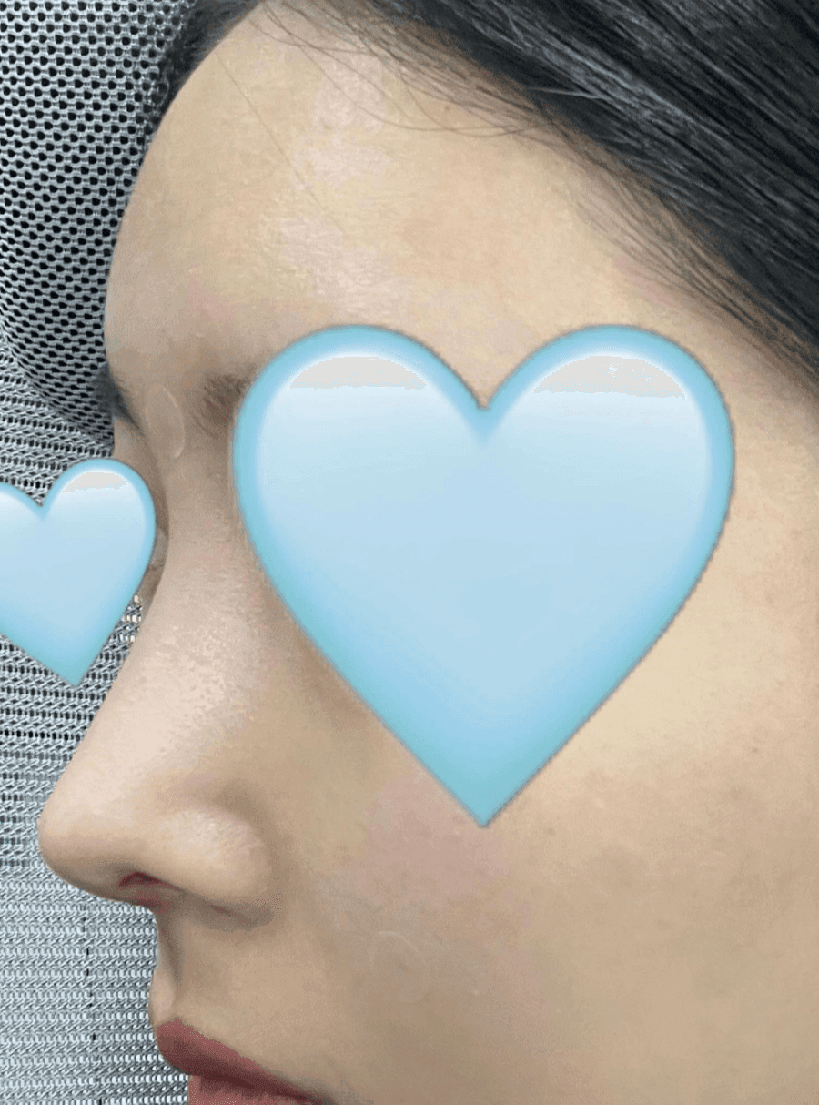 매부리코교정과 비염수술을 함께 진행한 사례 — 무보형물·귀연골로 계획한 이유 관련 이미지 5/14