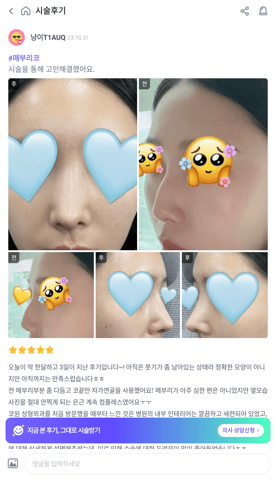 매부리코교정과 비염수술을 함께 진행한 사례 — 무보형물·귀연골로 계획한 이유 관련 이미지 6/14