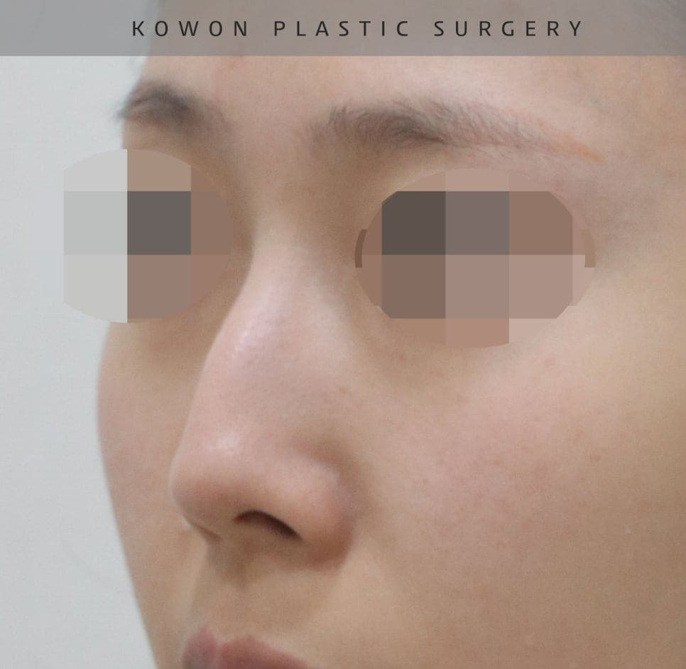 매부리코교정과 비염수술을 함께 진행한 사례 — 무보형물·귀연골로 계획한 이유 관련 이미지 7/14