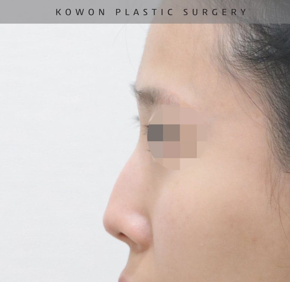 매부리코교정과 비염수술을 함께 진행한 사례 — 무보형물·귀연골로 계획한 이유 관련 이미지 8/14