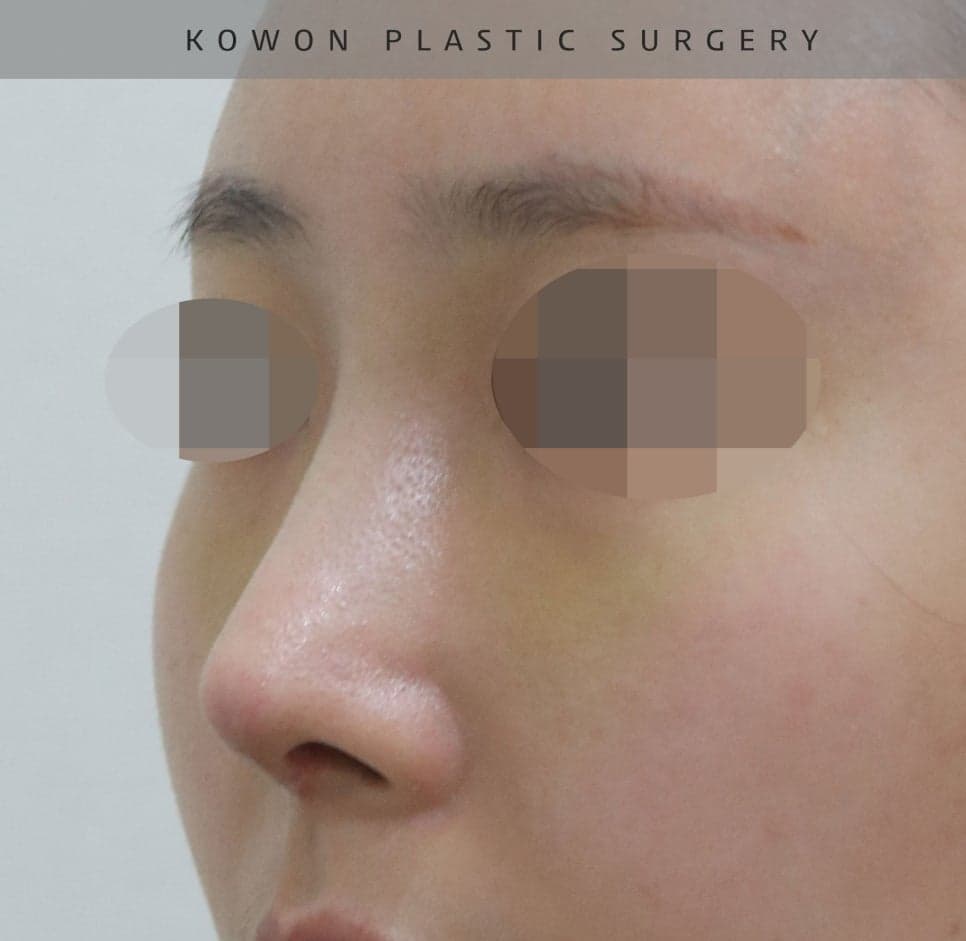 매부리코교정과 비염수술을 함께 진행한 사례 — 무보형물·귀연골로 계획한 이유 관련 이미지 9/14