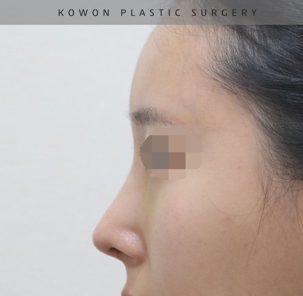 매부리코교정과 비염수술을 함께 진행한 사례 — 무보형물·귀연골로 계획한 이유 관련 이미지 10/14