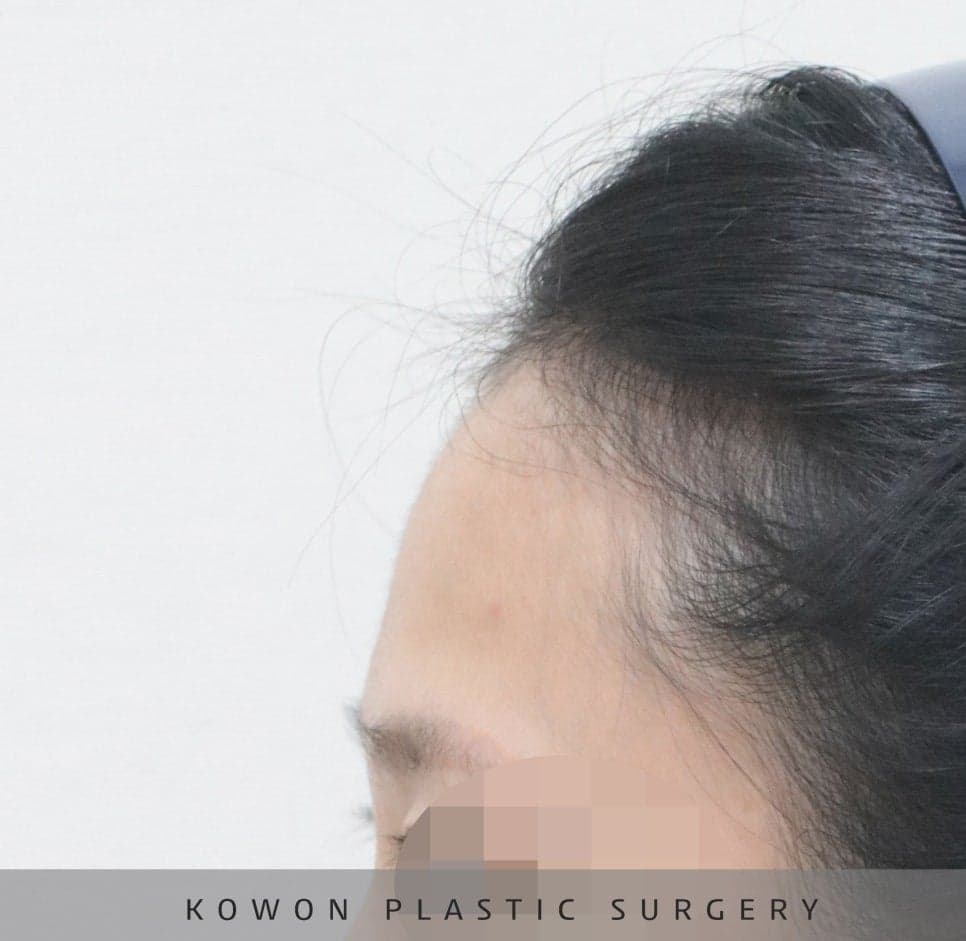 매부리코교정과 비염수술을 함께 진행한 사례 — 무보형물·귀연골로 계획한 이유 관련 이미지 12/14