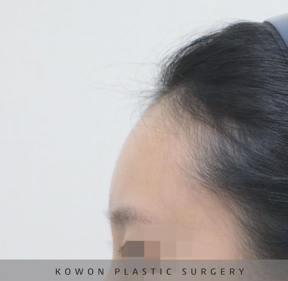 매부리코교정과 비염수술을 함께 진행한 사례 — 무보형물·귀연골로 계획한 이유 관련 이미지 14/14