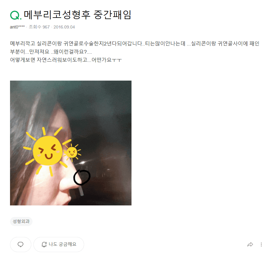 매부리코 수술 부작용이 걱정될 때 — 확인할 점과 매부리·휜코 동반 교정 사례 관련 이미지 2/9