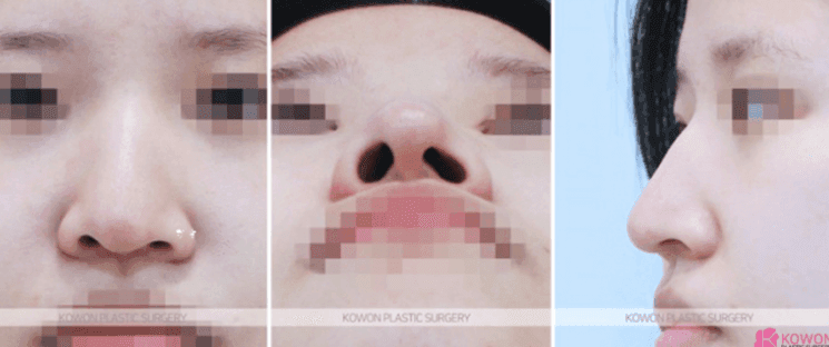 매부리코 수술 부작용이 걱정될 때 — 확인할 점과 매부리·휜코 동반 교정 사례 관련 이미지 4/9