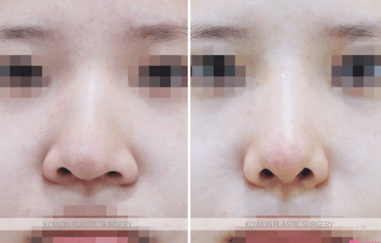 매부리코 수술 부작용이 걱정될 때 — 확인할 점과 매부리·휜코 동반 교정 사례 관련 이미지 6/9