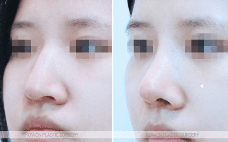 매부리코 수술 부작용이 걱정될 때 — 확인할 점과 매부리·휜코 동반 교정 사례 관련 이미지 7/9