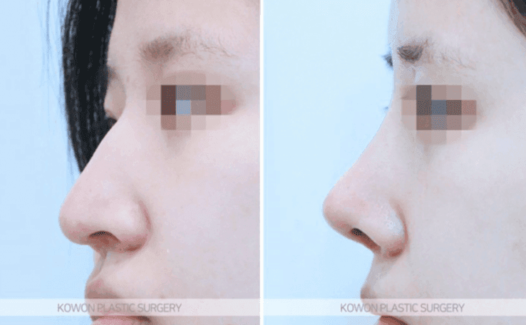 매부리코 수술 부작용이 걱정될 때 — 확인할 점과 매부리·휜코 동반 교정 사례 관련 이미지 8/9