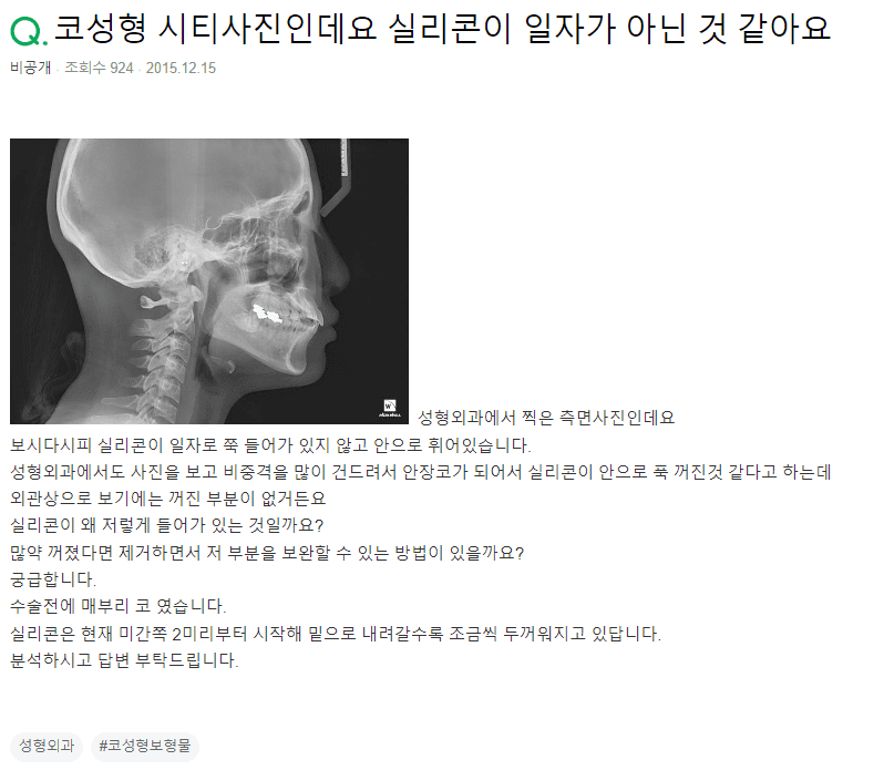หากซิลิโคนดูยุบตัวลงในภาพ CT สแกนหลังการผ่าตัดจมูกโหนก— ทำไมจึงเป็นเช่นนั้น ในเมื่อภายนอกดูปกติดี? ภาพที่เกี่ยวข้อง 2/2