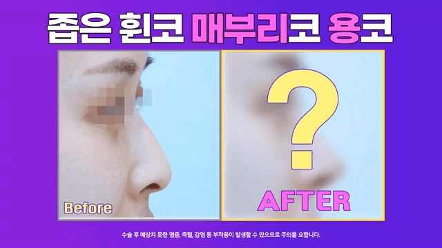 매부리코 교정 사례 — 실·필러를 먼저 제거해야 했던 이유와 2주차 경과 관련 이미지 1/8