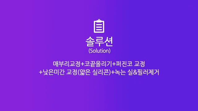 매부리코 교정 사례 — 실·필러를 먼저 제거해야 했던 이유와 2주차 경과 관련 이미지 3/8