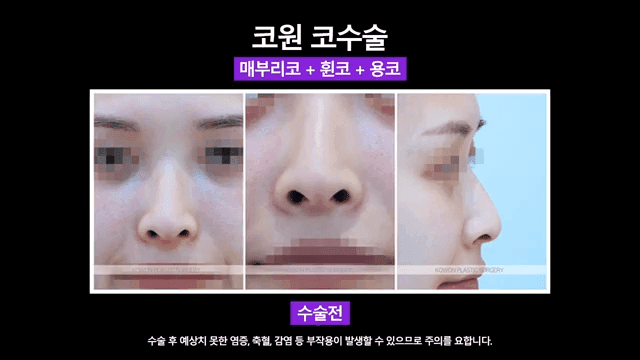 매부리코 교정 사례 — 실·필러를 먼저 제거해야 했던 이유와 2주차 경과 관련 이미지 4/8