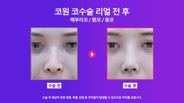 매부리코 교정 사례 — 실·필러를 먼저 제거해야 했던 이유와 2주차 경과 관련 이미지 5/8
