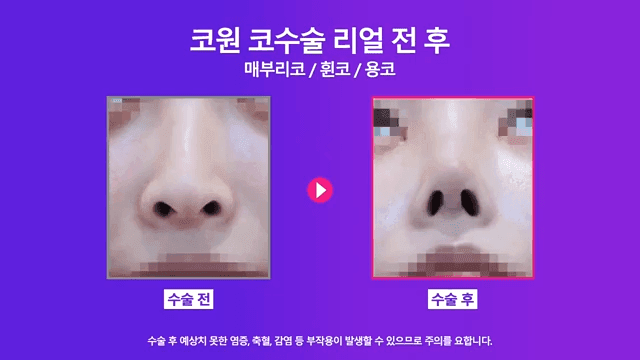 매부리코 교정 사례 — 실·필러를 먼저 제거해야 했던 이유와 2주차 경과 관련 이미지 6/8
