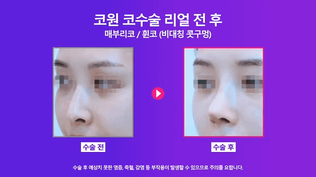 매부리코 교정 사례 — 실·필러를 먼저 제거해야 했던 이유와 2주차 경과 관련 이미지 7/8