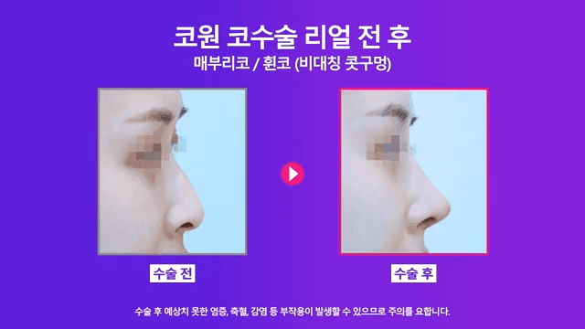 매부리코 교정 사례 — 실·필러를 먼저 제거해야 했던 이유와 2주차 경과 관련 이미지 8/8
