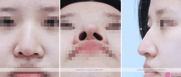 매부리코수술 2년 후 코끝이 패인 것처럼 만져진다면 — 부작용인지 확인하는 기준 관련 이미지 4/8