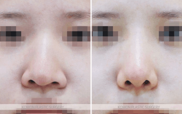 매부리코수술 2년 후 코끝이 패인 것처럼 만져진다면 — 부작용인지 확인하는 기준 관련 이미지 5/8