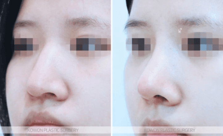 매부리코수술 2년 후 코끝이 패인 것처럼 만져진다면 — 부작용인지 확인하는 기준 관련 이미지 6/8