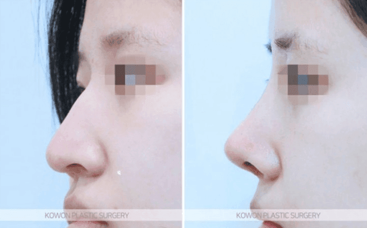 매부리코수술 2년 후 코끝이 패인 것처럼 만져진다면 — 부작용인지 확인하는 기준 관련 이미지 7/8