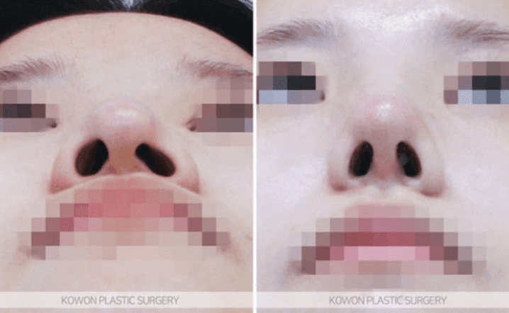매부리코수술 2년 후 코끝이 패인 것처럼 만져진다면 — 부작용인지 확인하는 기준 관련 이미지 8/8