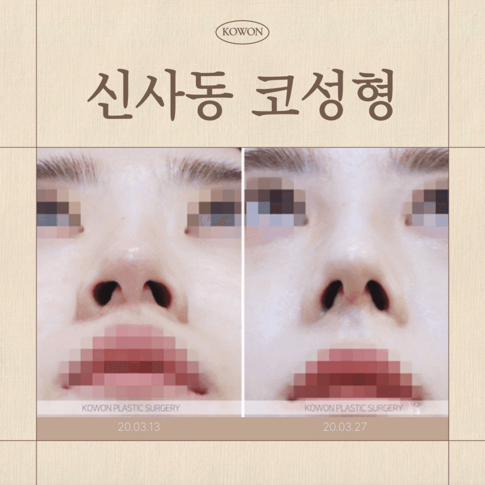 จมูกแบบไหนที่เหมาะสมกับการผ่าตัดจมูก ไม่ใช้อิมแพลนต์ไม่? — ภาพที่ 1/7 เกี่ยวข้องกับวัสดุสามชนิดและเกณฑ์การวิเคราะห์โครงสร้าง