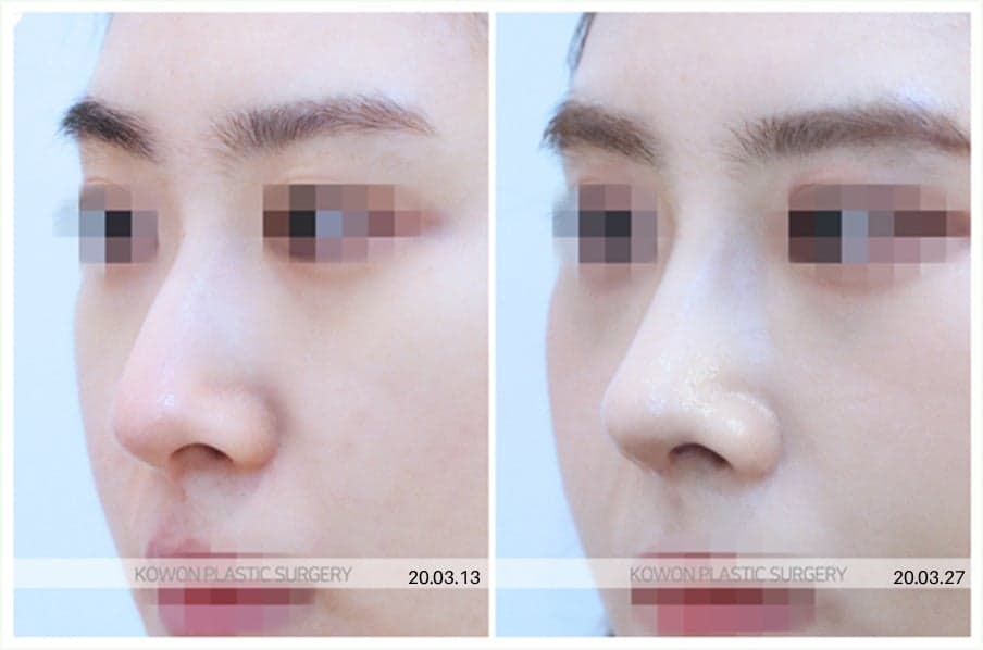 จมูกแบบไหนที่เหมาะสมกับการผ่าตัดจมูก ไม่ใช้อิมแพลนต์ไม่? — ภาพประกอบเกี่ยวกับวัสดุสามชนิดและเกณฑ์การวิเคราะห์โครงสร้าง 3/7