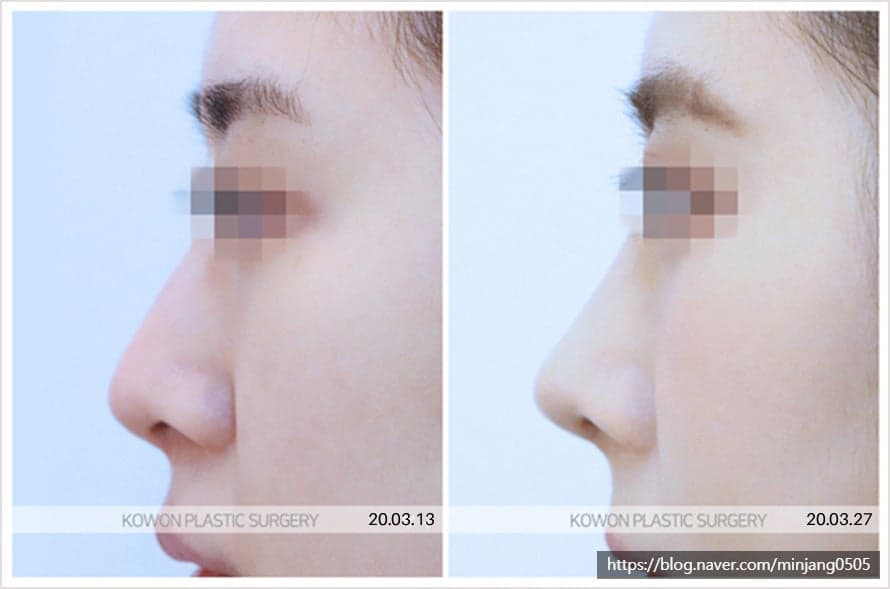 จมูกแบบไหนที่เหมาะสมกับการผ่าตัดจมูก ไม่ใช้อิมแพลนต์? — ภาพประกอบเกี่ยวกับวัสดุสามชนิดและเกณฑ์การวิเคราะห์โครงสร้าง 7/7