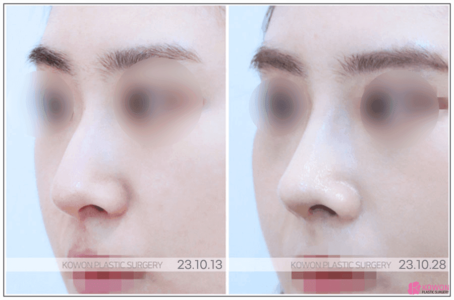무보형물 코수술, 구축 없이 오래 유지될 수 있을까 — 재료·적합 기준으로 보는 유지력 관련 이미지 5/7