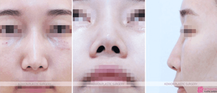 자려한코성형이란 무엇인가요 — 실·필러를 정리한 뒤 보형물 없이 라인을 만든 작은코 사례 관련 이미지 5/10