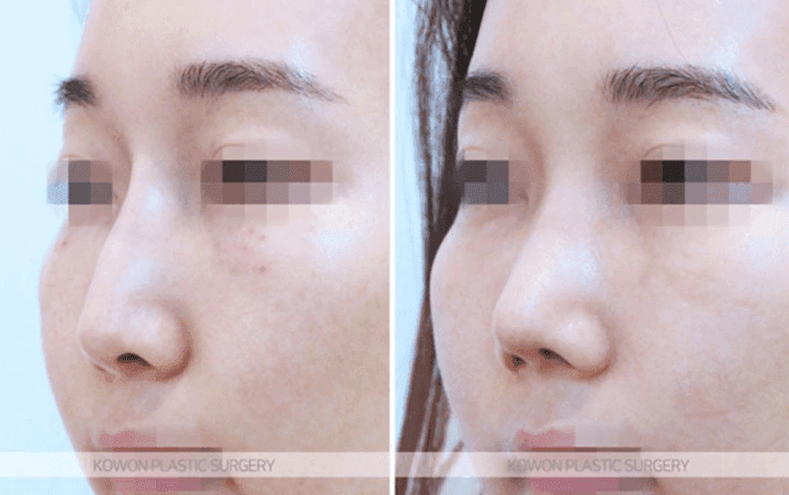 자려한코성형이란 무엇인가요 — 실·필러를 정리한 뒤 보형물 없이 라인을 만든 작은코 사례 관련 이미지 7/10