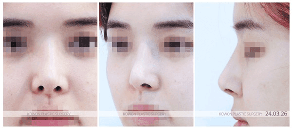 직반버선코, 직선과 곡선의 균형은 어떻게 잡나요 — 콧구멍 비대칭 동반 시 확인 순서 관련 이미지 4/9