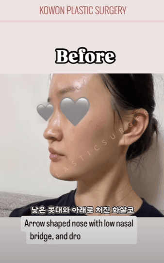 긴코수술은 어떻게 진행될까 — 처진코 원인 세 가지와 비중격·비주 조정, 회복 과정까지 관련 이미지 8/15