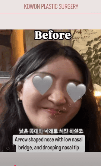 긴코수술은 어떻게 진행될까 — 처진코 원인 세 가지와 비중격·비주 조정, 회복 과정까지 관련 이미지 9/15