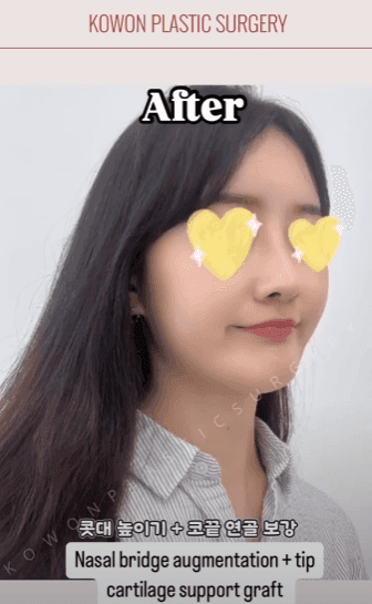 긴코수술은 어떻게 진행될까 — 처진코 원인 세 가지와 비중격·비주 조정, 회복 과정까지 관련 이미지 10/15